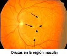 oeil avec macula drusen