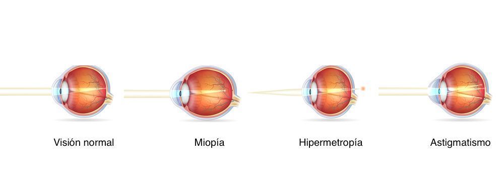errores refractivos