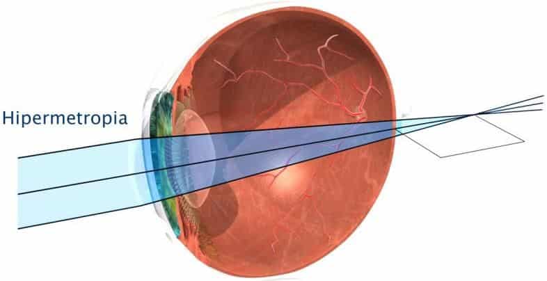 farsightedness