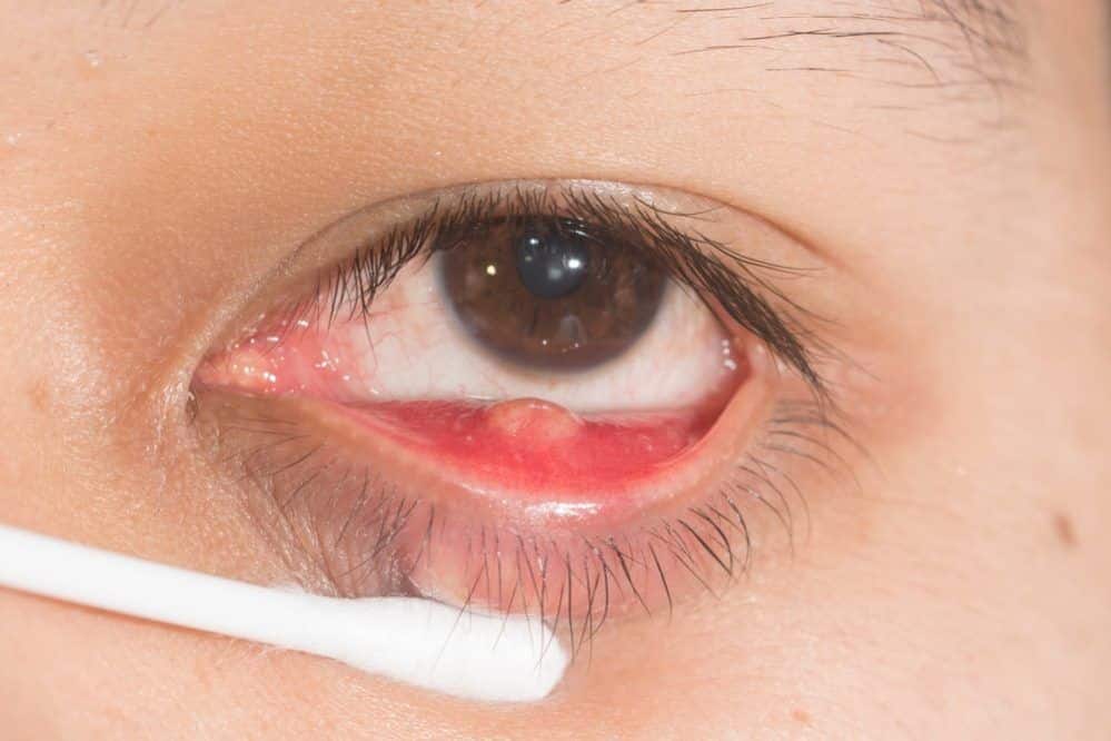 Internal stye what is it, causes and treatment Área oftalmológica