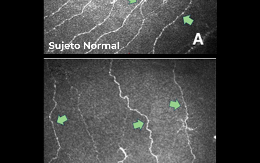 El estudio de los nervios de la córnea mediante microscopía confocal, como biomarcador temprano en la enfermedad de Alzheimer
