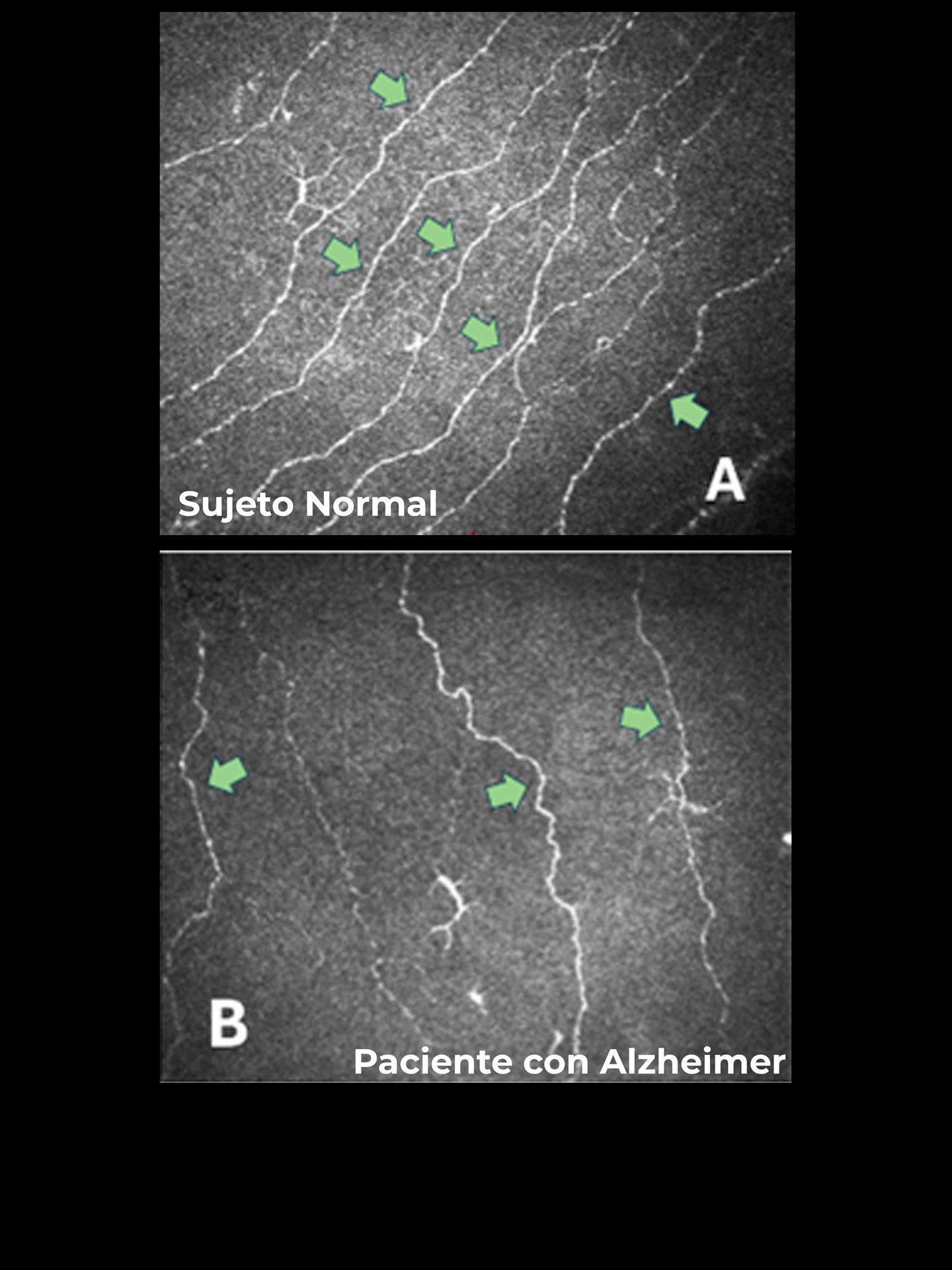 ALZHEIMER