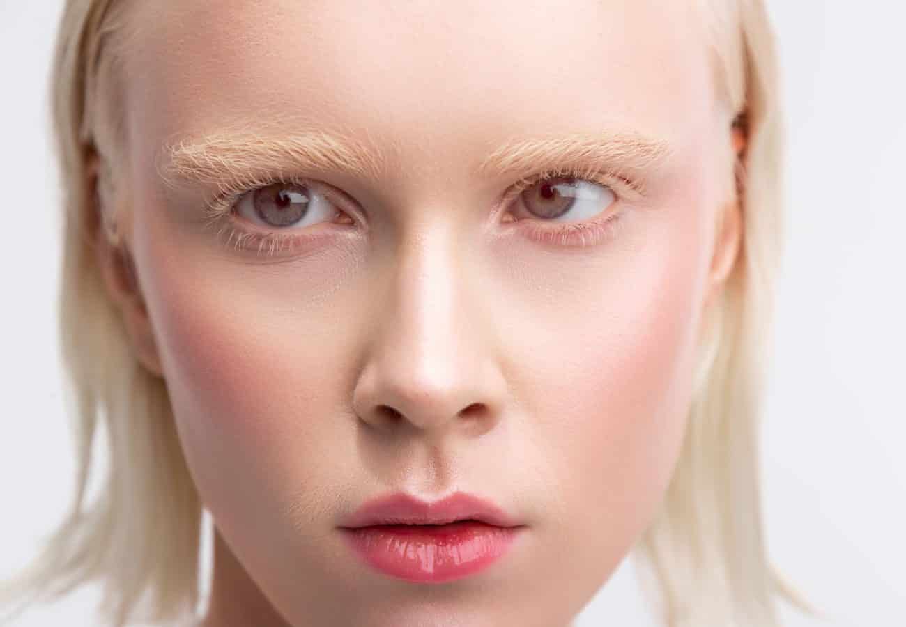 albinisme oculaire