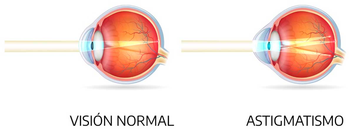 sintomas de astigmatismo