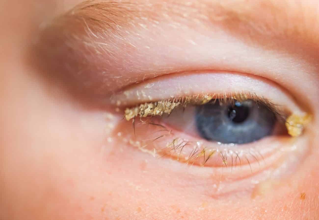 Conjuntivitis En Niños | Área Oftalmológica Avanzada