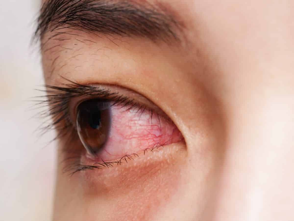 conjuntivitis