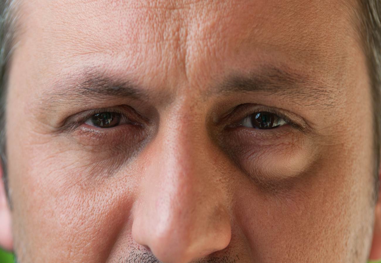 Edema Palpebral Qu Es rea Oftalmol gica Avanzada