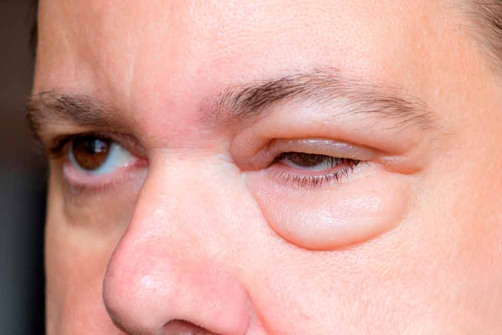 Edema Palpebral Qu Es Tipos Y Causas GRWZC