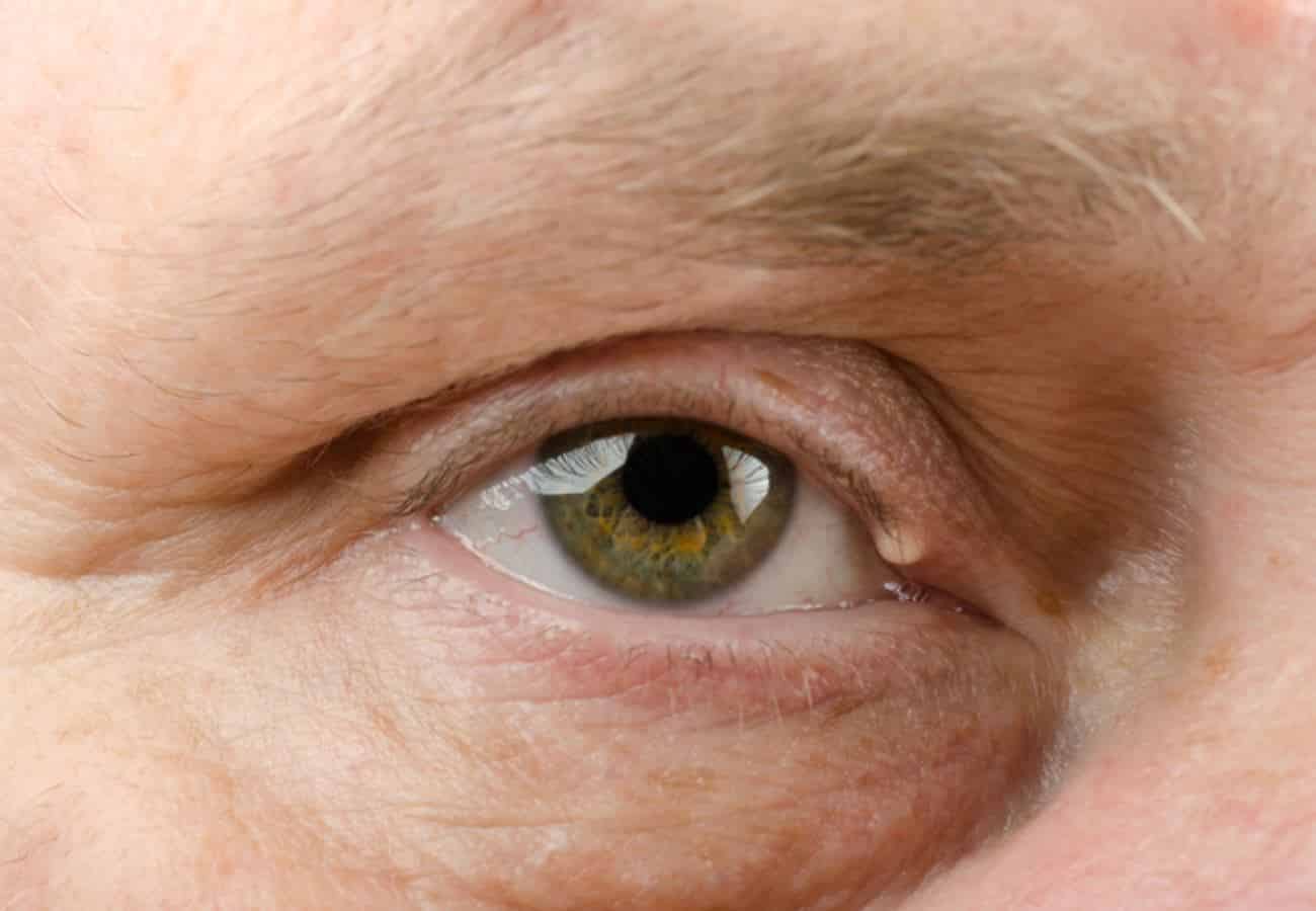 Dermatitis en el ojo