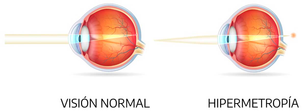 Farsightedness