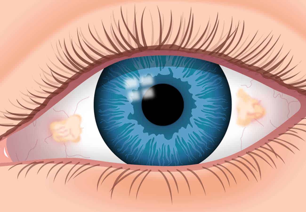 What Does White Spot On Eye Mean Infoupdate
