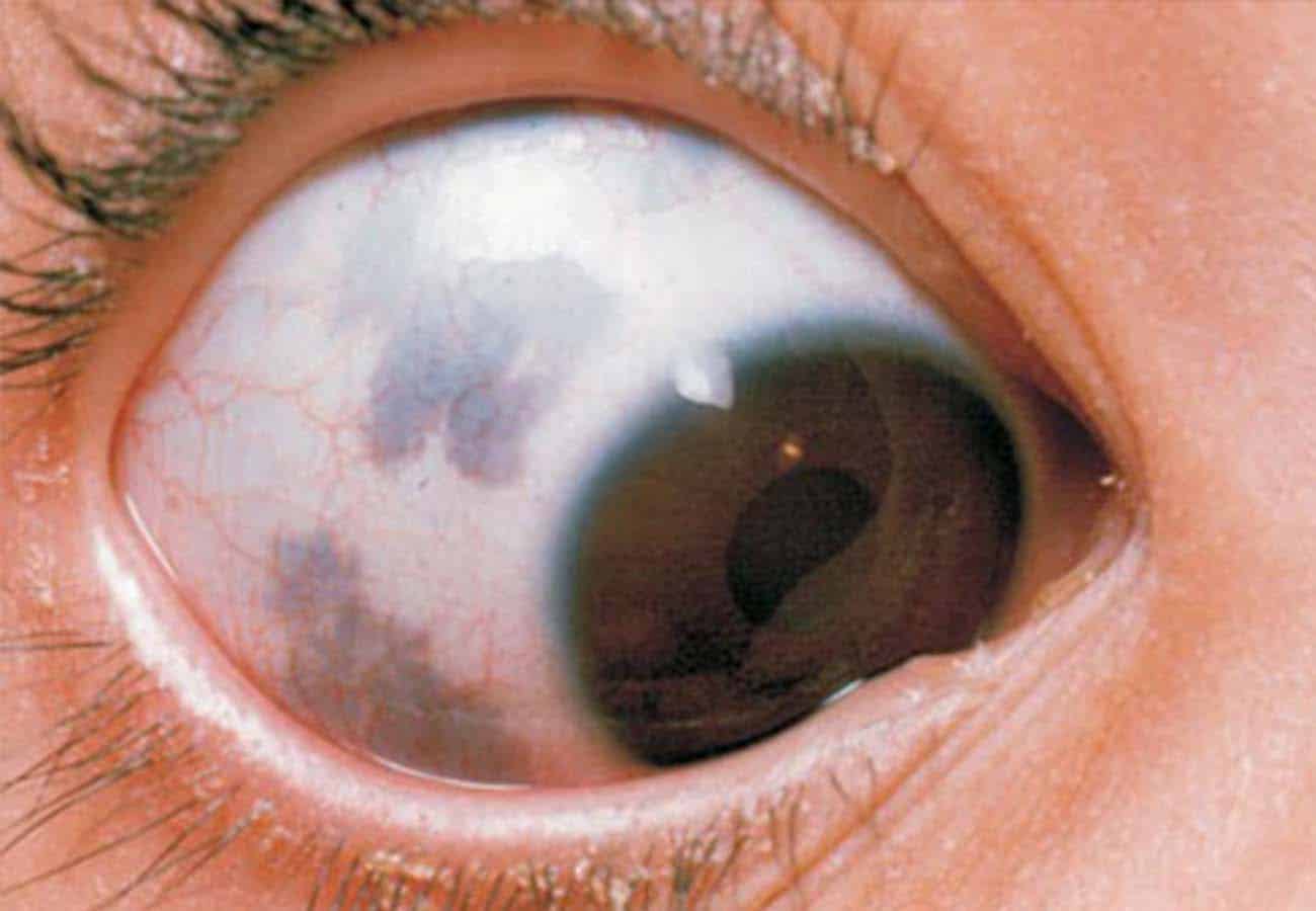 Black Dot In Eye During Pregnancy