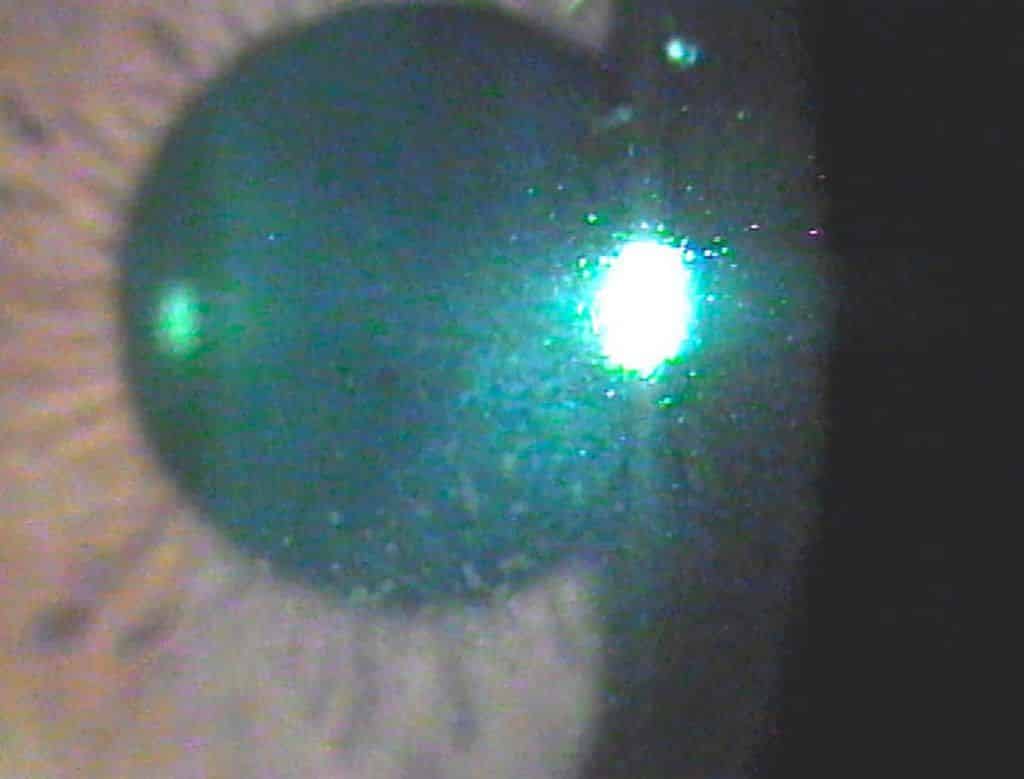 queratitis punctata
