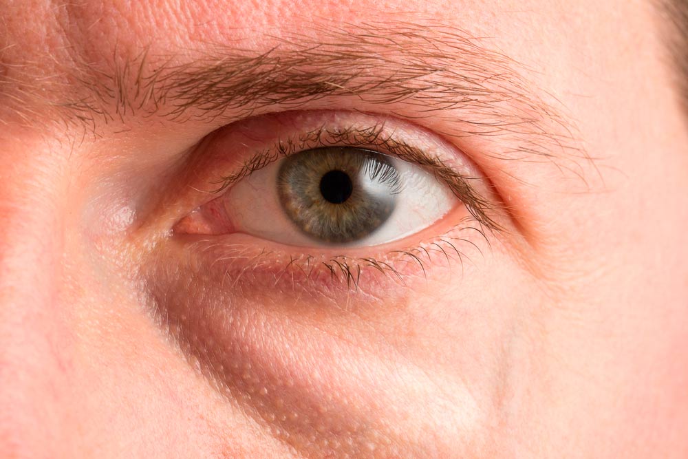 Edema Palpebral Qu Es Tipos Y Causas GRWZC