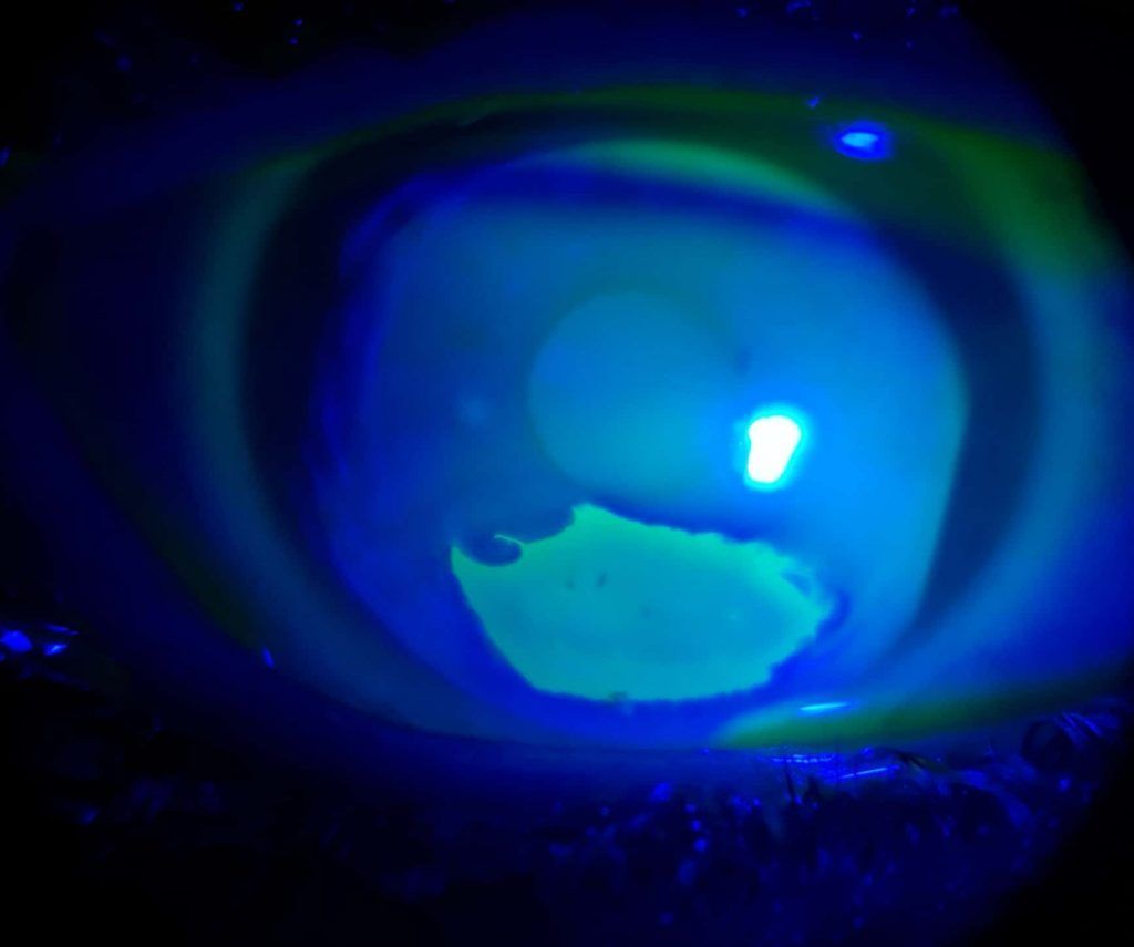 ulcera corneal con fluoresceina